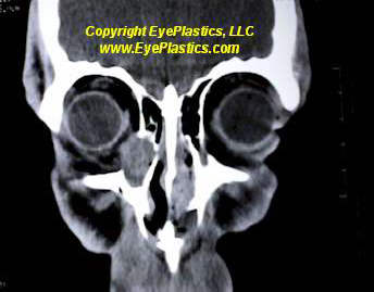 Orbital Tumors - Lacrimal Sac 